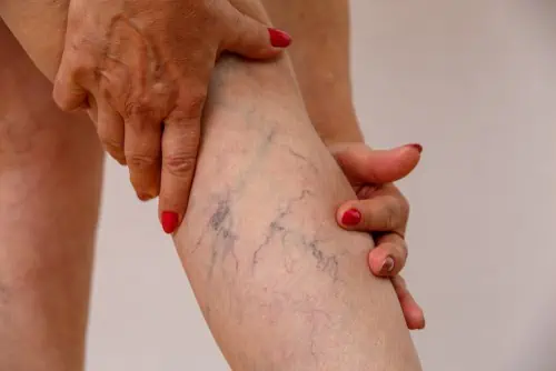 How Sclerotherapy Happens